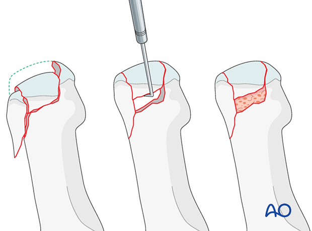 Grafting of the metaphyseal cancellous bone of an impacted proximal complete articular fracture of the 1st metatarsal