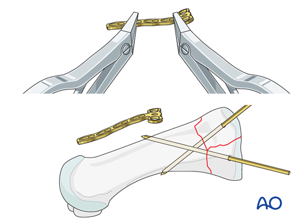 Plate contouring for fixation of a proximal complete articular fracture of the 1st metatarsal