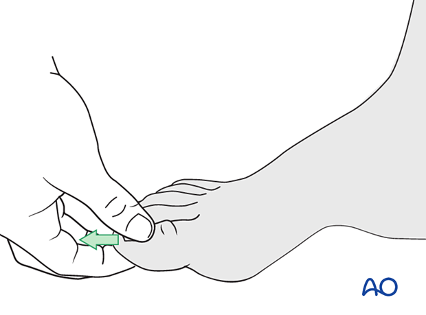 Closed reduction of a metatarsal fracture with manual traction
