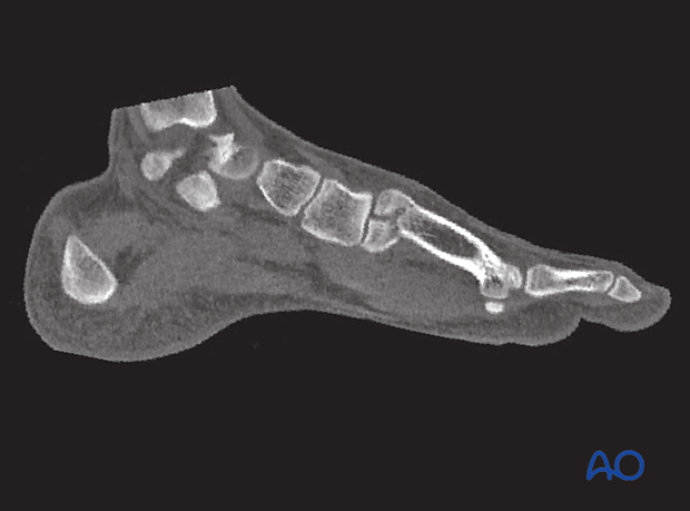 Preoperative CT scan showing a simple displaced articular split fracture of the base of the first metatarsal. 