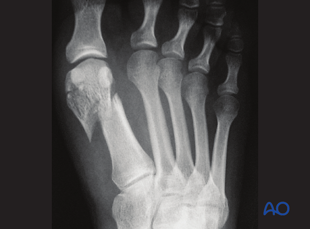 extraarticular fracture of the distal end segment of the first metatarsal