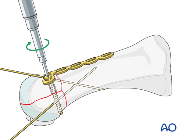 Lag screw fixation of the articular block of a proximal complete articular fracture of the 1st metatarsal