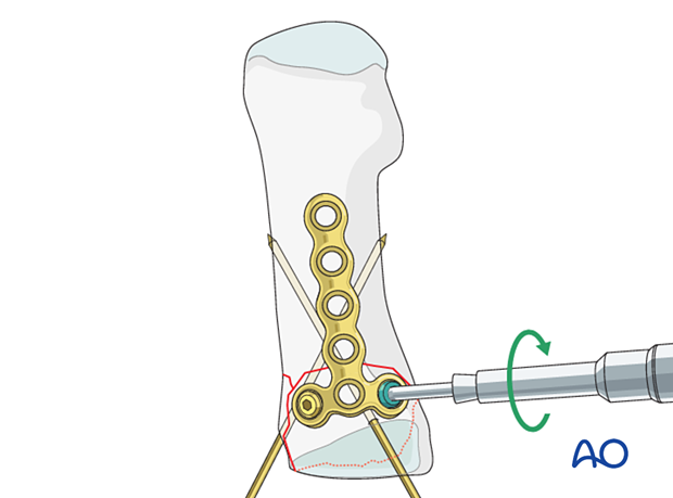 Insertion of a locking head screw into the articular block of a proximal complete articular fracture of the 1st metatarsal