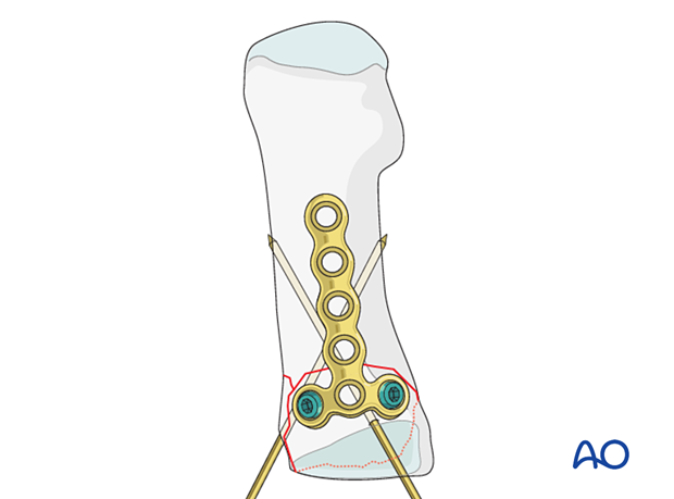 Locking head screw fixation of the articular block of a proximal complete articular fracture of the 1st metatarsal