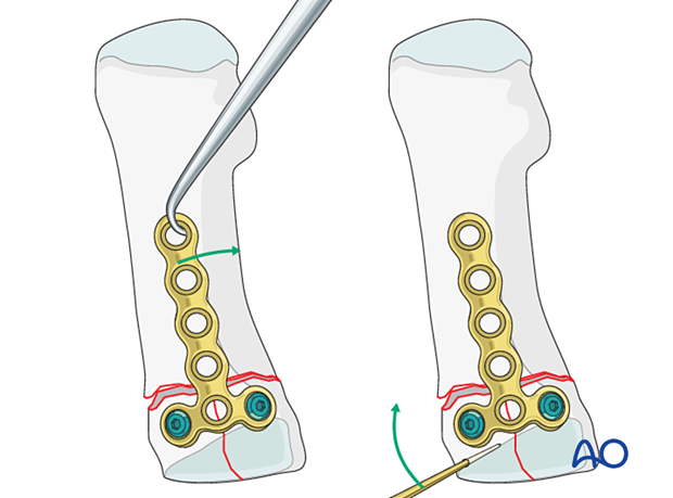 Reduction of the articular block to the shaft of a proximal complete articular fracture of the 1st metatarsal