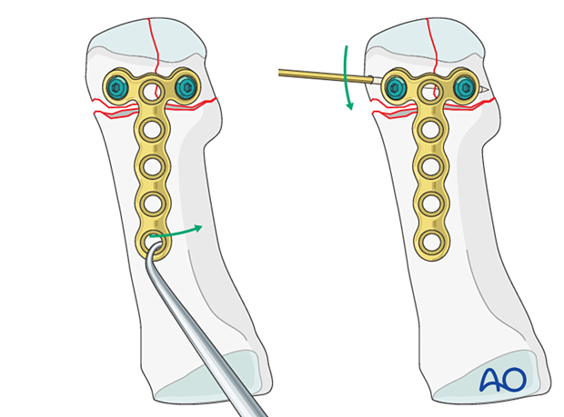 Reduction of the articular block to the shaft of a distal complete articular fracture of the 1st metatarsal