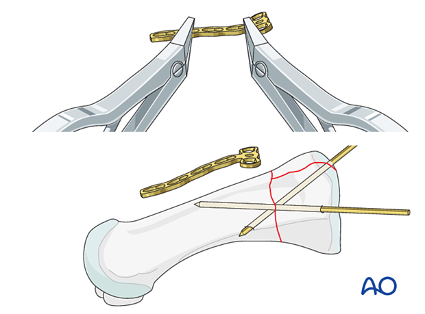 Plate contouring for fixation of a proximal complete articular fracture of the 1st metatarsal