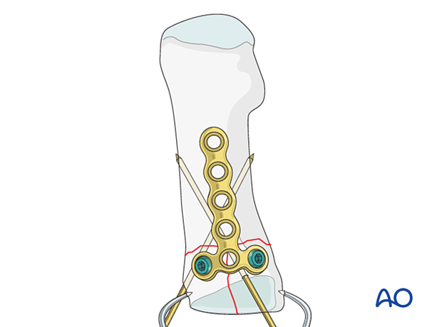Insertion of locking screws into the articular block of a proximal complete articular fracture of the 1st metatarsal