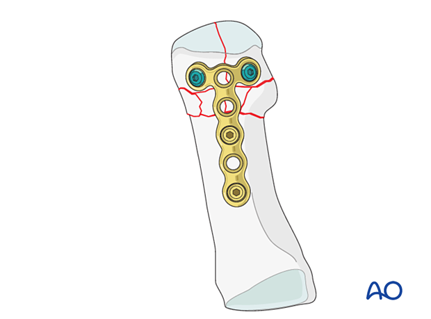 Bridge plating of a distal complete articular fracture of the 1st metatarsal with metaphyseal comminution