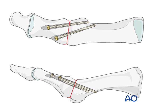 Arthrodesis of the 1st MTP joint with lag screws