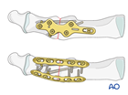 Arthrodesis of the 1st MTP joint with screws and a neutralization fusion plate 