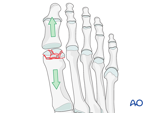Mini distractor applied to improve visualization of a distal articular fracture of the 1st metatarsal