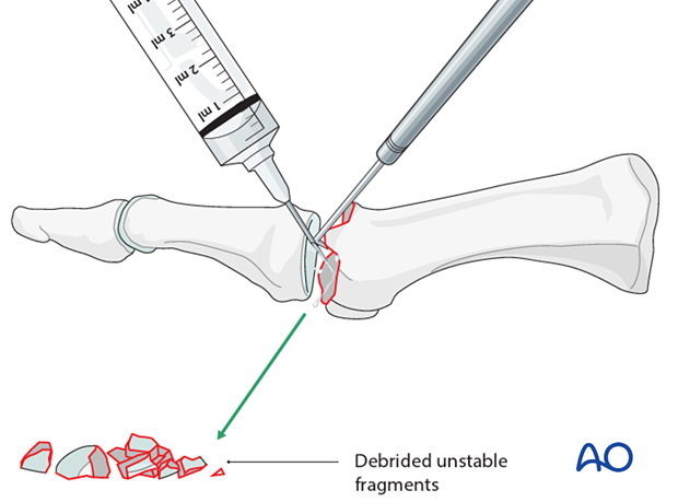Irrigation and debridement of a distal articular fracture of the 1st metatarsal