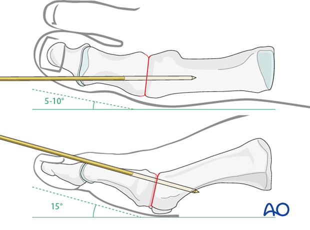 Positioning and temporary K-wire fixation of the 1st MTP joint for arthrodesis