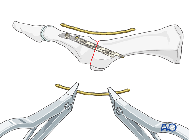 Plate contouring for arthrodesis of the 1st MTP joint