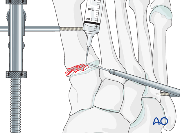 Irrigation of a proximal articular fracture of the 1st metatarsal