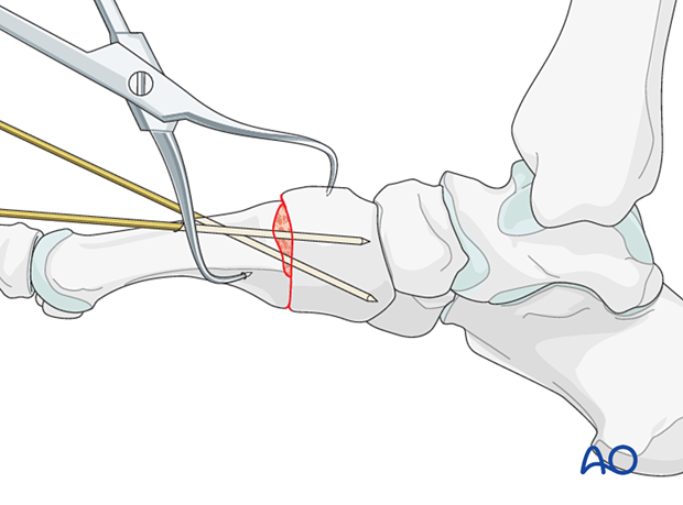 Temporary fixation for arthrodesis of the TMT joint of the 1st metatarsal
