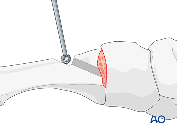 Countersinking for lag screw fixation of the TMT joint of the 1st metatarsal