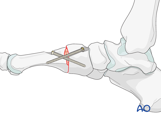 Lag screw fixation for arthrodesis of the TMT joint of the 1st metatarsal