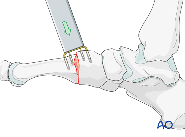 Staple fixation for arthrodesis of the TMT joint of the 1st metatarsal
