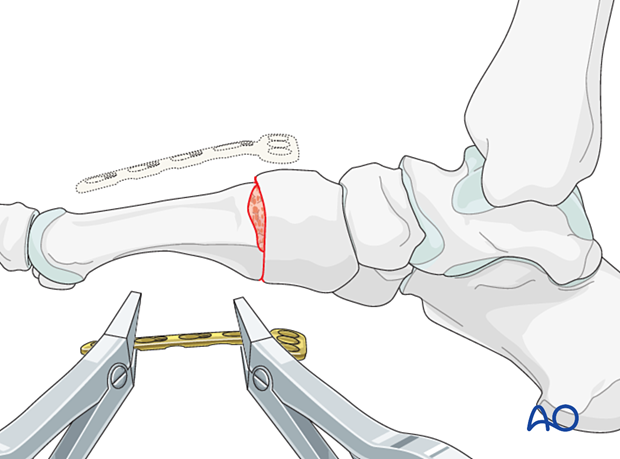 Plate contouring for arthrodesis of a TMT joint