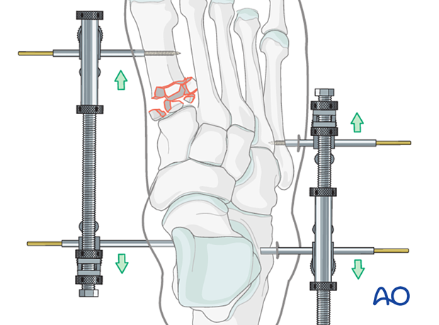 Medial- and lateral-column distractor applied to improve visualization of a length unstable proximal 1st metatarsal fracture