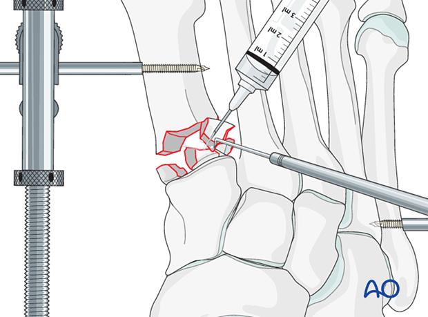 Irrigation of a proximal articular fracture of the 1st metatarsal