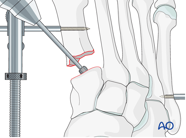 Promoting bone growth by penetrating the subchondral bone for arthrodesis of the 1st TMT joint