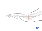 Temporary K-wire immobilization for excision arthroplasty of the MTP joint 