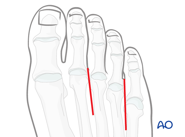 Skin incision between the metatarsal heads 4 and 5