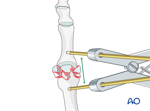 Applied minidistractor to expose the articular surfaces of the MTP joint