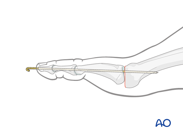 K-wire insertion for temporary support of the arthroplasty of the MTP joint