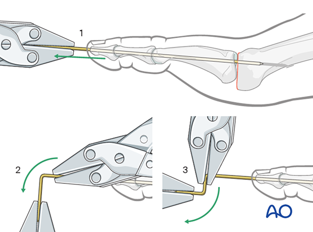 Bending the end of the K-wire during excision arthroplasty of the MTP joint