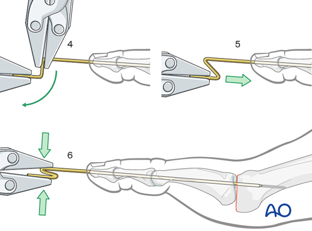 Bending the end of the K-wire during excision arthroplasty of the MTP joint