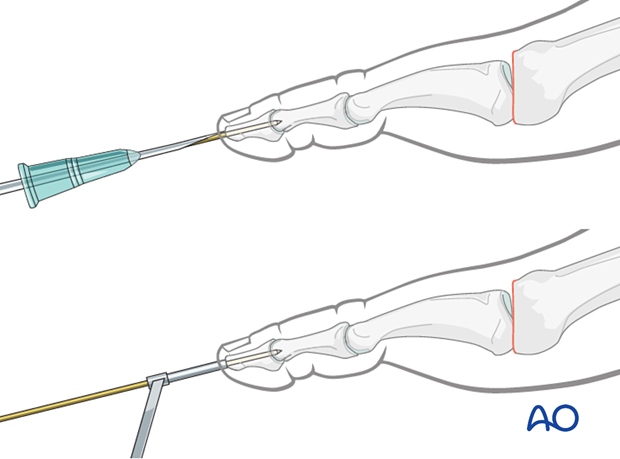 Use of a drill guide for K-wire insertion into the phalanx