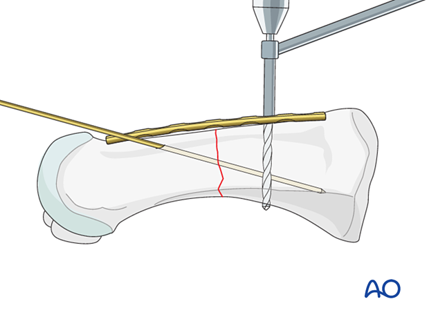 Drilling for plate fixation of a transverse metatarsal fracture