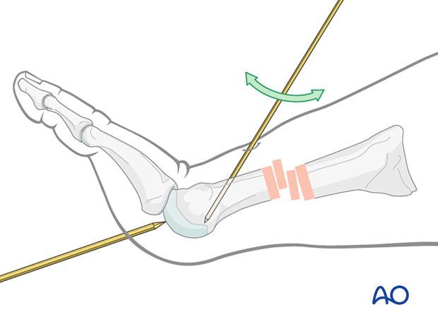 Retrograde insertion of an intramedullary K-wire into the distal end of a metatarsal for fixation of a diaphyseal fracture and K-wire joystick manipulation of the distal fragment