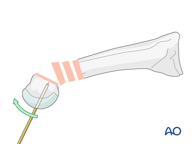 K-wire joystick reduction of a distal extraarticular metatarsal fracture