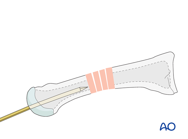 Retrograde insertion of an intramedullary K-wire into the distal end of a metatarsal for fixation of a multifragmentary diaphyseal fracture