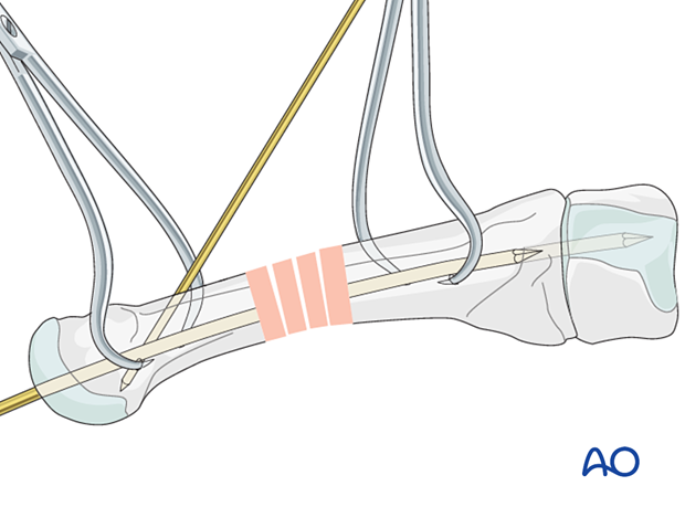 Intramedullary K-wire fixation of a diaphyseal metatarsal fracture