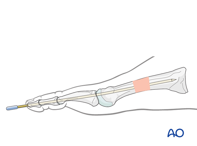 Intramedullary K Wire Fixation For Distal Extraarticular Fractures Of