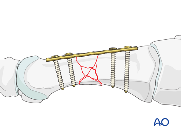 Bridge plating of a diaphyseal multifragmentary fracture of the 1st metatarsal