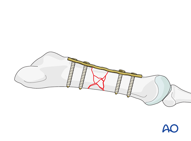 Bridge plating of a diaphyseal multifragmentary fracture of the 5th metatarsal