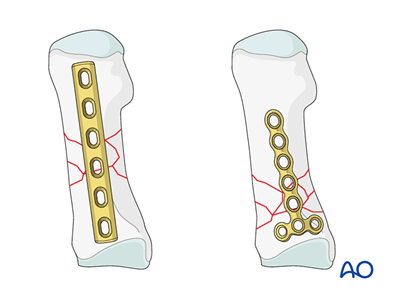 Bridge plate fixation for Multifragmentary diaphyseal and proximal ...