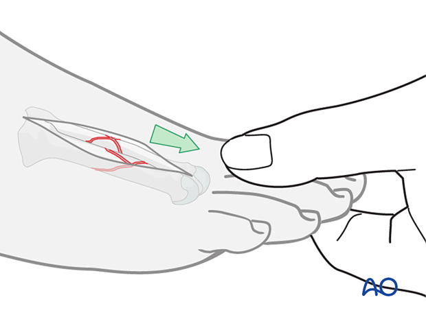 Reduction of a multifragmentary diaphyseal fracture of the metatarsals by manual traction