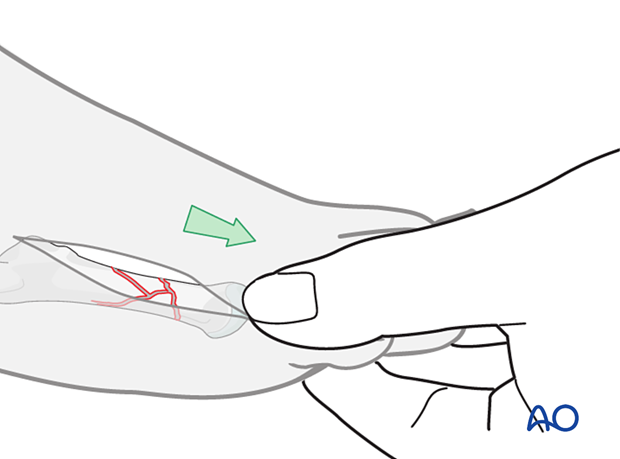 Reduction of a multifragmentary diaphyseal fracture of the metatarsals by manual traction