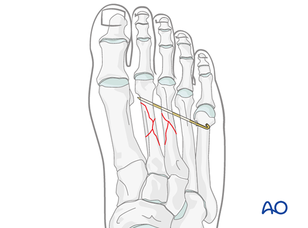 Temporary K-wire fixation of a multifragmentary diaphyseal fracture of the metatarsals