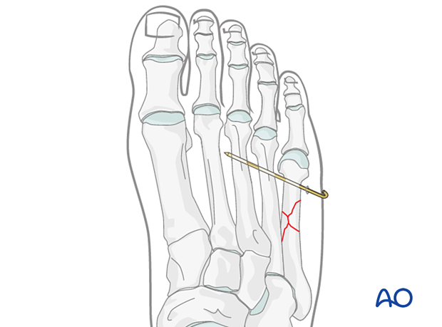 Temporary K-wire fixation of a multifragmentary diaphyseal fracture of the 5th metatarsals