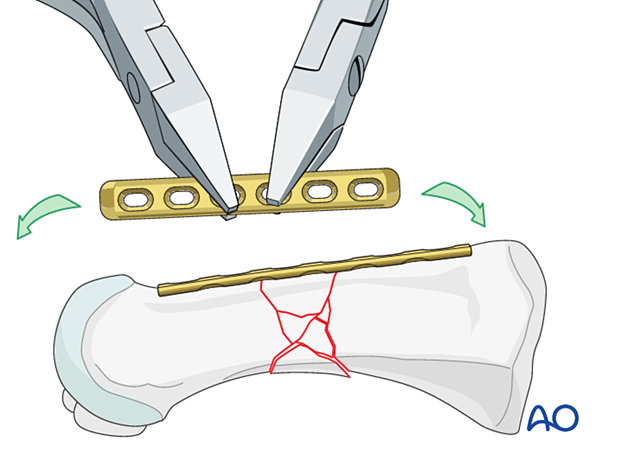 Plate contouring for bridge plating of a multifragmentary diaphyseal fracture of the 1st metatarsal