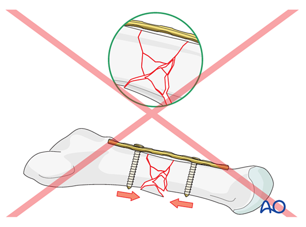 No overbending of the plate for bridge plating of a multifragmentary diaphyseal fracture of the 5th metatarsal